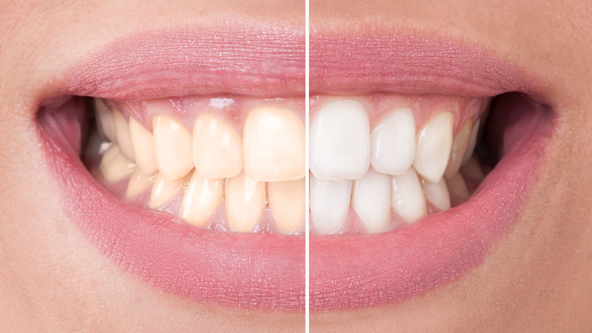 Teeth Whitening