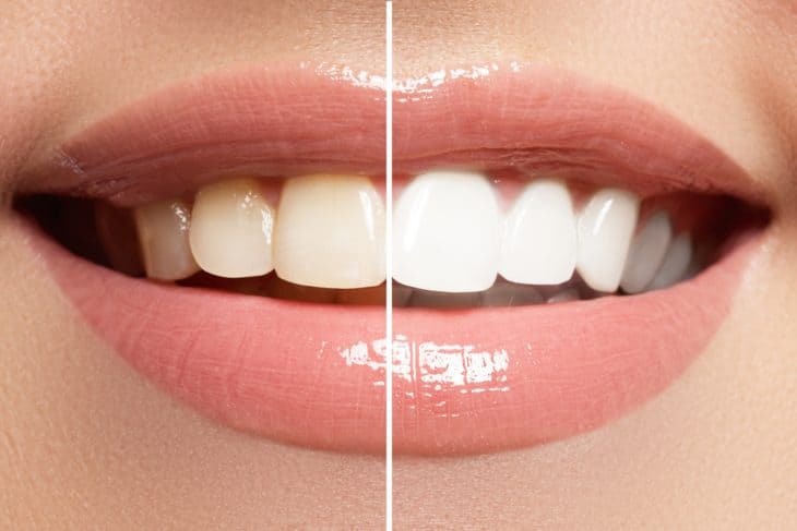 Is Teeth Whitening Safe?