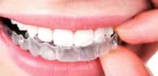 Why Are Invisible Braces Are So Popular?